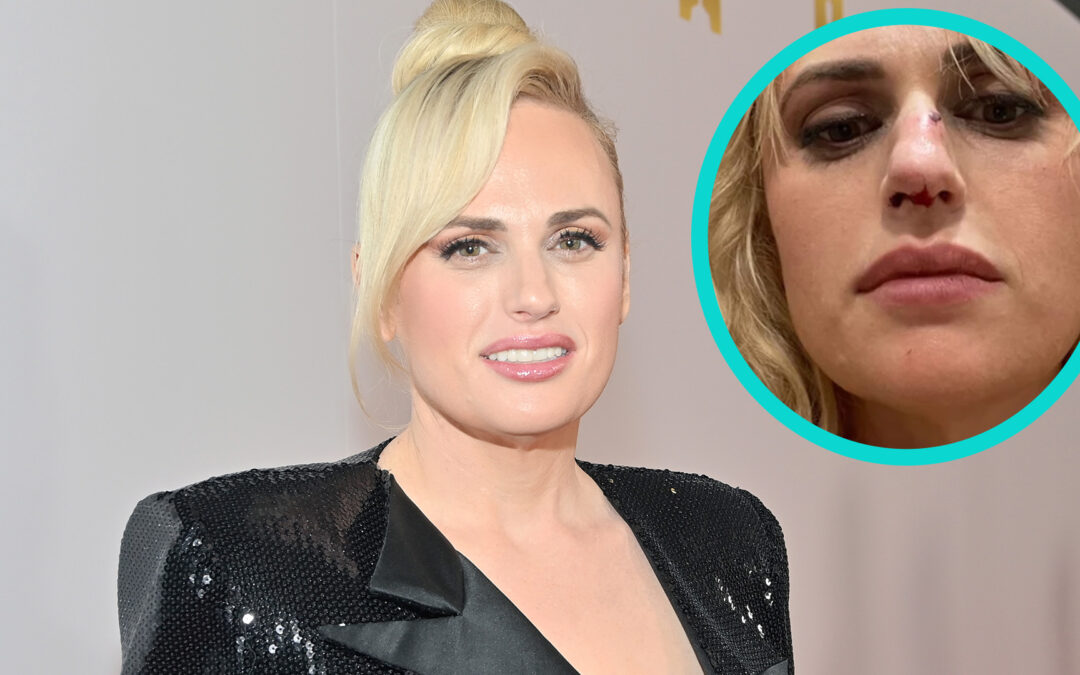 Rebel Wilson Was Hospitalized Following The Act In Bride Hard | Radiant ...