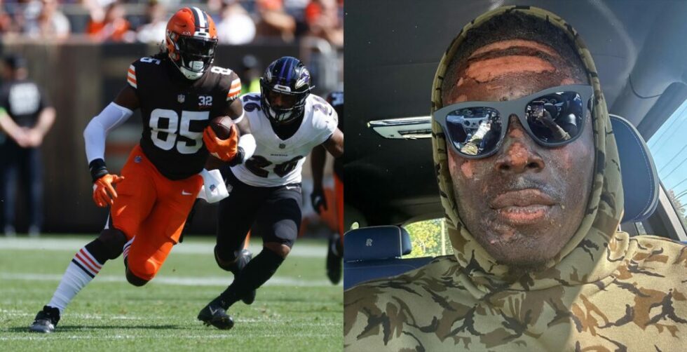 David Njoku Reveals His Complete Face Burns From A Home Accident ...